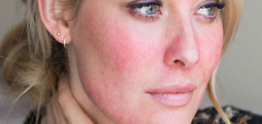 Soins pour peau sèche et irritée