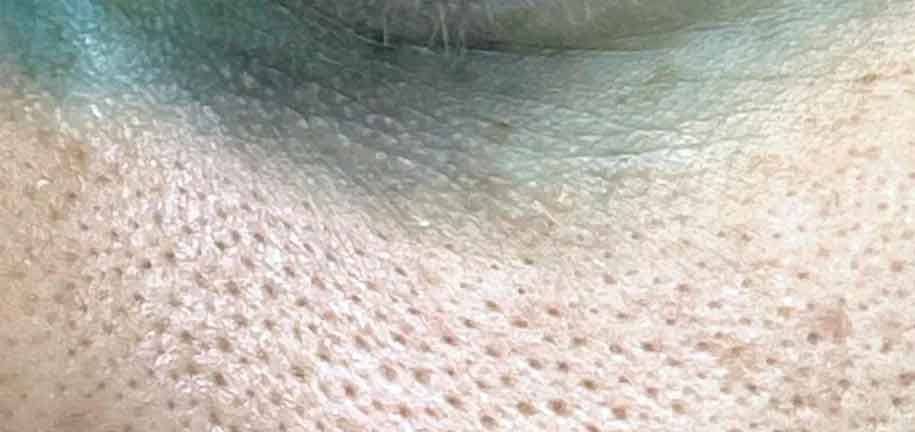 Pores dilatés sur le visage