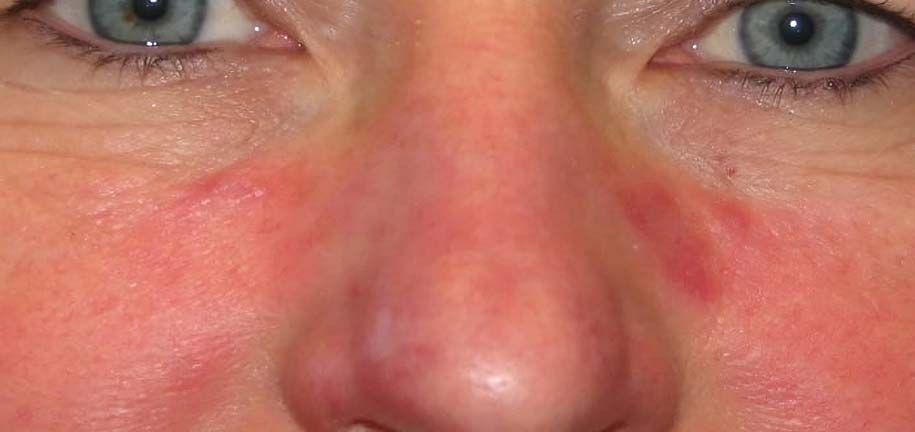 Routine Peau Séborrhéique