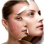 Soins de la peau pour l'acné