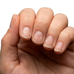 Ongles cassants
