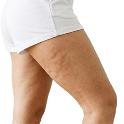 Produits de soin contre la cellulite pour le corps