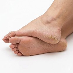 Produits pour les pieds secs et talons crevassés, peau rugueuse et épaissie