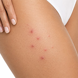Produits professionnels pour poils incarnés pour une peau plus lisse visage et corps