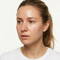 Soins pour peau grasse