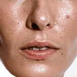 Soins pour peau grasse