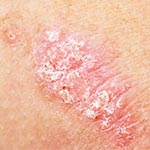 Crèmes et traitements pour le psoriasis pour peau sèche et squameuse