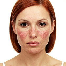 Produits de soin pour rougeurs du visage et peau sensible