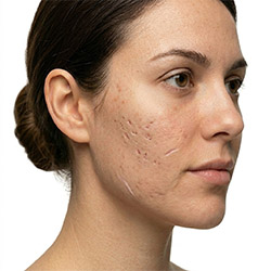 Produits de soin pour cicatrices visibles et texture de peau irrégulière visage et corps