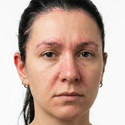 Soins pour la peau séborrhéique pour le visage et le cuir chevelu