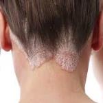 Séborrhée soins de la peau