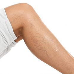 Produits de soin des pieds pour améliorer l’apparence des veines visibles et la texture de la peau