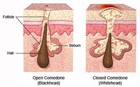 points noirs et pores